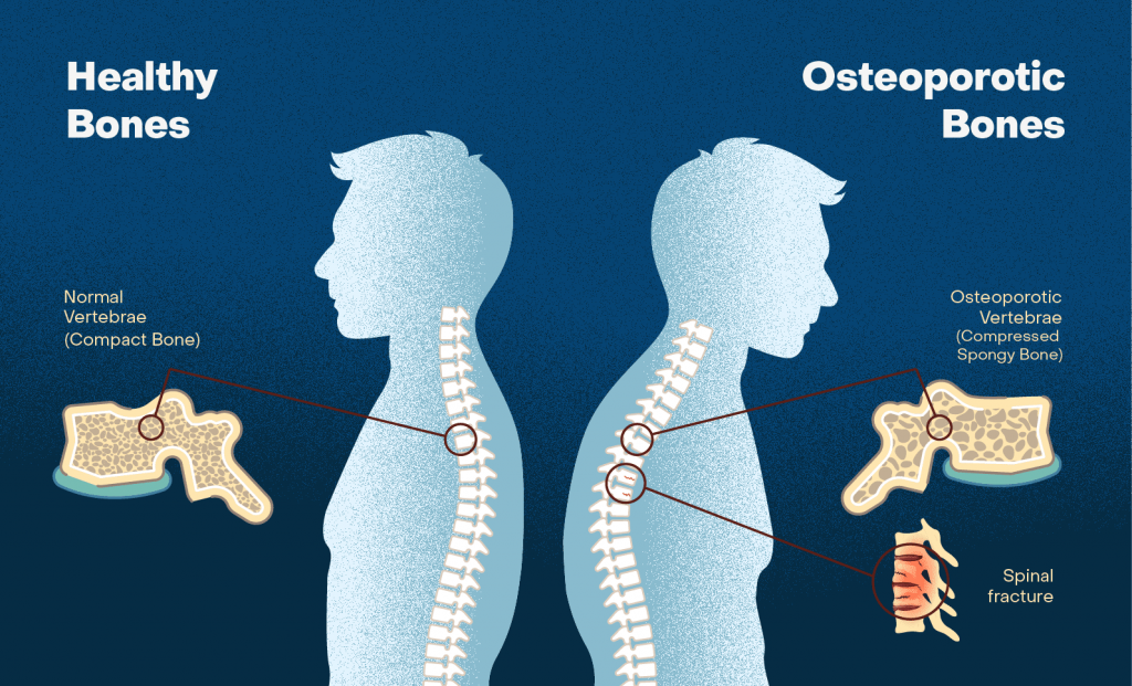 Healthy Bones Vs osteoporotic bones- A medical condition